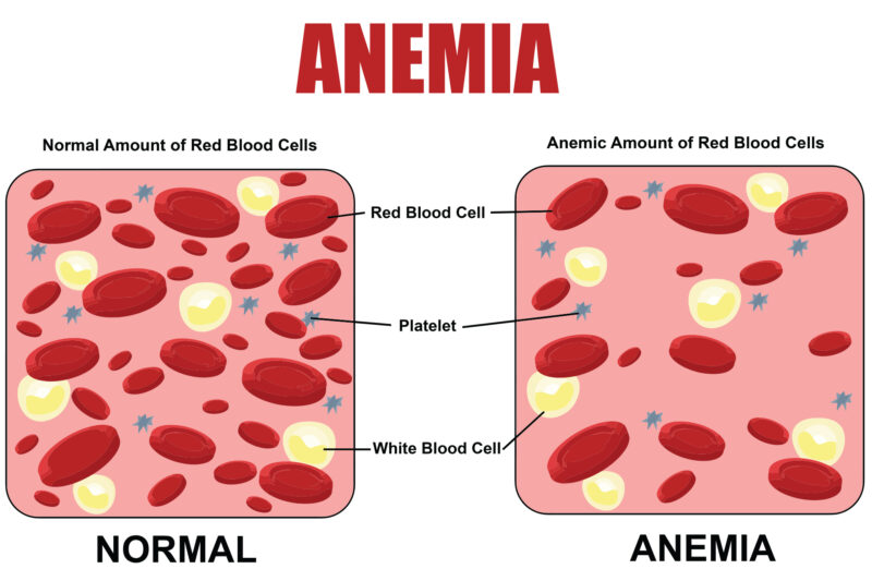 Anemia - Signature Health Services