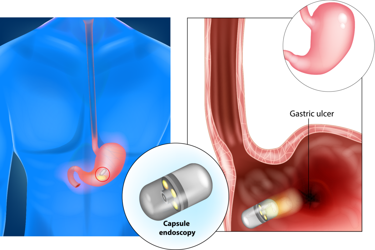 Gastric Ulcers Signature Health Services 