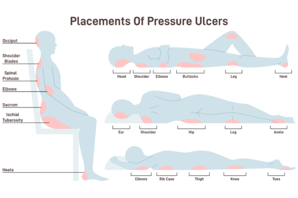 Pressure Ulcers Bedsores Signature Health Services